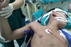 Bệnh nhân sau ca phẫu thuật cấp cứu. (Ảnh: TTXVN phát)