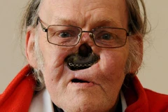 Gương mặt kinh dị của người đàn ông tội nghiệp. (Nguồn: Mirror)