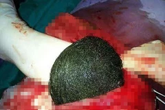 Búi tóc lớn bằng quả dưa trong bụng nữ bệnh nhân. (Nguồn: Dailymail)