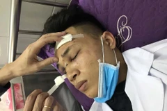 Thương tích trên vùng mặt của bác sỹ Lê Ngọc Sơn. (Ảnh: Tiến Vĩnh/TTXVN)