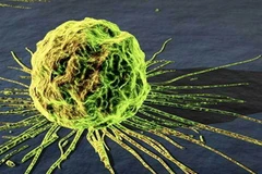 Tế bào ung thư. Ảnh minh họa. (Nguồn: khoahoc.com.vn)