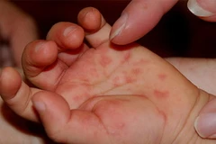 Bệnh tay chân miệng ở trẻ. (Nguồn: Internet)