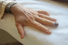 Tay của ông L.A.Tankard sau phẫu thuật.