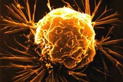 Tế bào ung thư. (Ảnh minh họa: Internet).