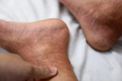 Một trường hợp mắc bệnh sốt xuất huyết. (Ảnh: Minh Quyết/Vietnam+)