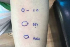 Hình ảnh test lẩy da cho thấy bệnh nhân có phản ứng với bột bánh mì. (Ảnh: Bác sĩ cung cấp)