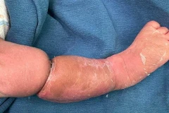 Hình ảnh dải sợi ối siết cẳng chân bệnh nhi