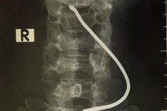 Hình ảnh chiếc thanh sắt cắm vào cổ bệnh nhân. (Ảnh: PV/Vietnam+)