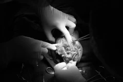 Các bác sỹ thực hiện ca phẫu thuật cho bệnh nhân. (Ảnh: PV/Vietnam+)