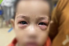 Bệnh nhi đau mắt đỏ. (Ảnh: PV/Vietnam+)