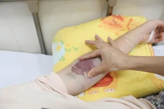 Một bệnh nhân mắc sốt xuất huyết trong tình trạng nặng. (Ảnh: PV/Vietnam+)