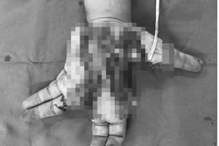 Nam bệnh nhân với bàn tay trái bị dập nát. (Ảnh: PV/Vietnam+)