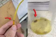 Hình ảnh sán lá gan chui ra từ ống dẫn lưu đường mật. (Ảnh: PV/Vietnam+)