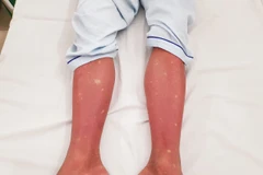 Hình ảnh xuất huyết trên chân của bệnh nhân sốt xuất huyết. (Ảnh: PV/Vietnam+)