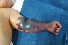 Cứu thành công cánh tay bị hoại tử tím đen cho 1 trẻ sinh non 