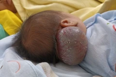 Hình ảnh khối u của bệnh nhân trước khi phẫu thuật. (Ảnh: BVCC)