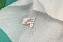 Dị vật được lấy ra khỏi thực quản của bệnh nhân. (Ảnh: PV/Vietnam+)