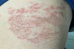 Bệnh nhân mắc ấu trùng giun đũa chó. (Ảnh: PV/Vietnam+)