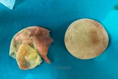 Túi ngực vỡ của bệnh nhân được lấy ra khỏi cơ thể. (Ảnh: PV/Vietnam+)