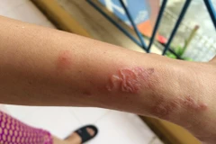 Tay của một bệnh nhân nhiễm giun đũa chó, mèo từ thú cưng trong nhà. (Ảnh: PV/Vietnam+)