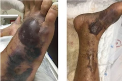 Một bệnh nhân bị nhiễm trùng máu do vi khuẩn Vibrio vulnificus. (Ảnh: PV/Vienam+)