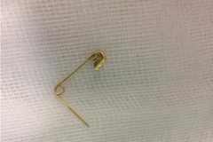 Chiếc kim băng được lấy ra từ thực quản của bé. (Ảnh: PV/Vietnam+)