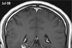 Sán dây dài 1cm sống trong não người đàn ông trong suốt 4 năm