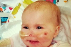 Cảm động nghị lực của bé gái mất tứ chi vì bệnh viêm màng não