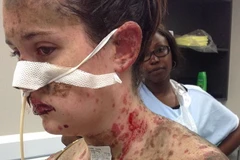 Suýt mất mạng vì dị ứng với thuốc điều trị bệnh động kinh