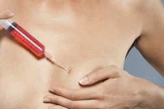 Nâng ngực tạm thời bằng nước muối ẩn chứa nhiều nguy cơ