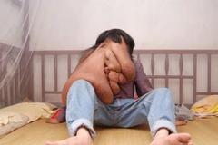 "Người đàn ông mặt voi" phẫu thuật cắt khối u nặng tới 25kg