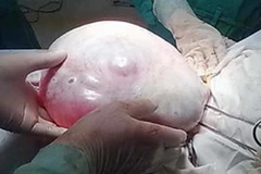 Phẫu thuật thành công khối u nang buồng trứng 4kg