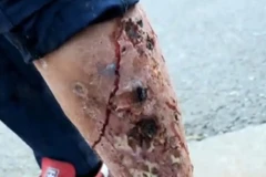 Xylazine - Hiểm họa từ thuốc giảm đau gây nghiện núp bóng thuốc an thần