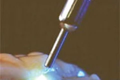 Laser chẩn đoán bệnh. (Nguồn: Internet)