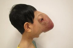 Khuôn mặt Lê Trung Tuấn trước khi mổ. (Ảnh: Tấn Lời/Vingroup)