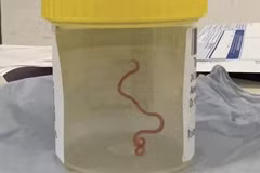 con giun trong não bệnh nhân. (Nguồn: ScienceNews)