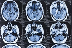 Nghiên cứu: COVID-19 có thể để lại di chứng ở não người bệnh 