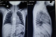 Sóc Trăng: Gắp thành công đồng xu trong bụng một bé gái