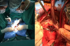 Phẫu thuật cứu sống bệnh nhân phình động mạch, biến chứng nguy kịch