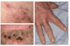 Mỹ và châu Âu đẩy mạnh cuộc chiến chống bệnh đậu mùa khỉ