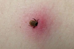Hơn 14% dân số thế giới mắc bệnh Lyme do bọ chét cắn gây ra
