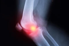 Những người sử dụng NSAID bị viêm khớp nặng hơn. (Nguồn: scitechdaily.com)