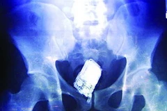 Ảnh chụp XQuang chiếc điện thoại di động được nuốt vào trong ổ bụng của một phạm nhân (Ảnh tư liệu)