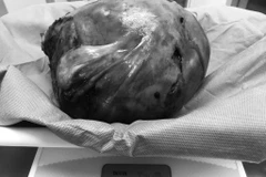 Khối u được bóc tách ra khỏi cơ thể bệnh nhân. (Ảnh: TTXVN phát)