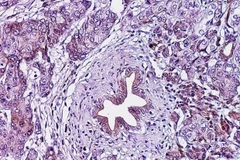 Lớp cắt biểu bì ung thư tuyến tụy. (Nguồn: eurekalert.org)