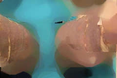 Nữ bệnh nhân bị bỏng phức tạp vùng da đùi sau hút mỡ. 