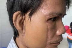 Bệnh nhân khi đã được ghép tai. (Ảnh: TTXVN phát)