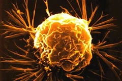 Tế bào ung thư vú. (Nguồn: Internet)