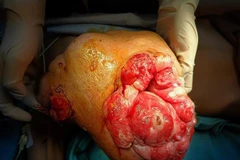 Khối u sau khi được phẫu thuật. (Ảnh: TTXVN phát)