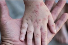 Ban đậu mùa khỉ nổi trên tay của một em nhỏ mắc bệnh. (Ảnh: Reuters/TTXVN)
